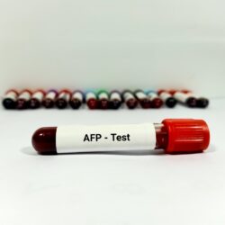 Alfa Fetoprotein Testi (AFP) Nedir
