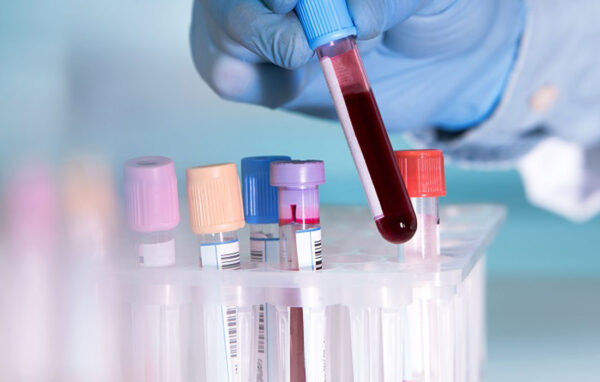 Gebelikte Tam Kan Sayımı Testinin Önemi Nedir