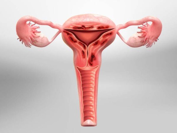 Adenomyozis Nedir