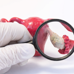 Yumurtalık Kistlerinin Alınması