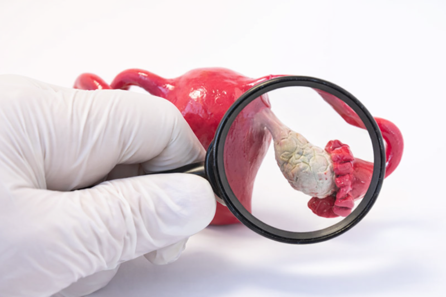 Yumurtalık Kistlerinin Alınması