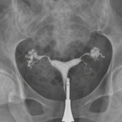 Hidrosalpenks Ameliyatı