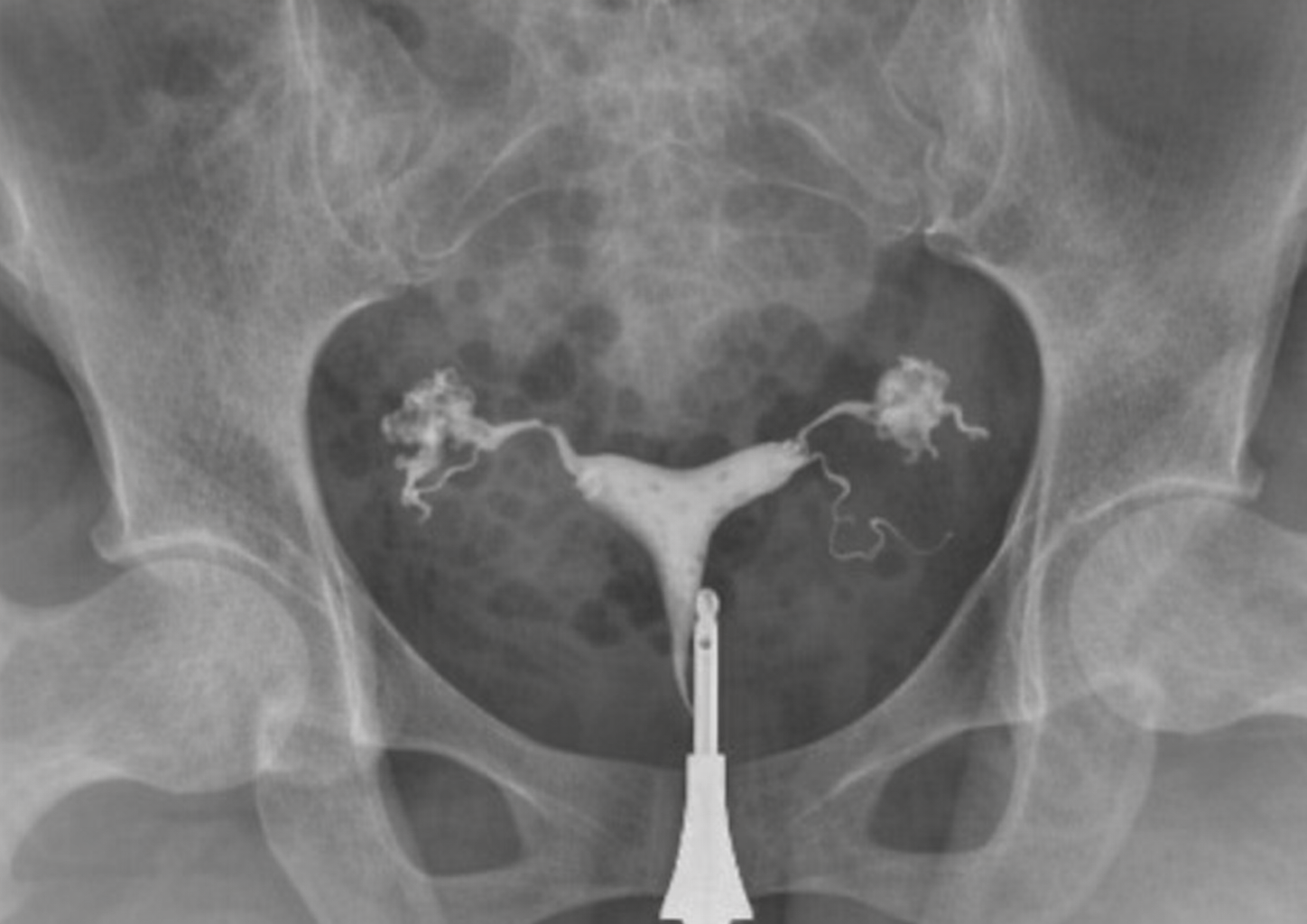 Hidrosalpenks Ameliyatı