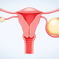 Yumurtalık Kistlerinin Alınması